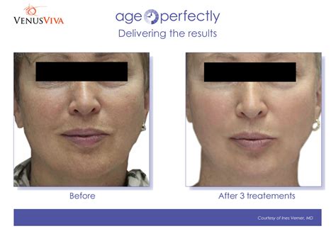 venus viva skin resurfacing edmonton|Venus Viva – Flawless Laser and Body Sculpting.